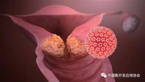 吃瓜12岁感染hpv,揭示青少年宫颈癌防控刻不容缓